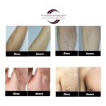 TB Tamer Bayrakçeken IPL Lazer Epilasyon Cihazı 990.000 Atım Manuel & Otomatik Mod – Acısız Kalıcı Tüy Giderme – 5 Seviye Işık - Görsel 3