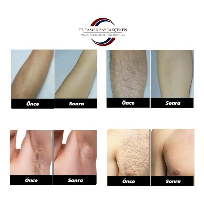 TB Tamer Bayrakçeken IPL Lazer Epilasyon Cihazı 990.000 Atım Manuel & Otomatik Mod – Acısız Kalıcı Tüy Giderme – 5 Seviye Işık - Görsel 3